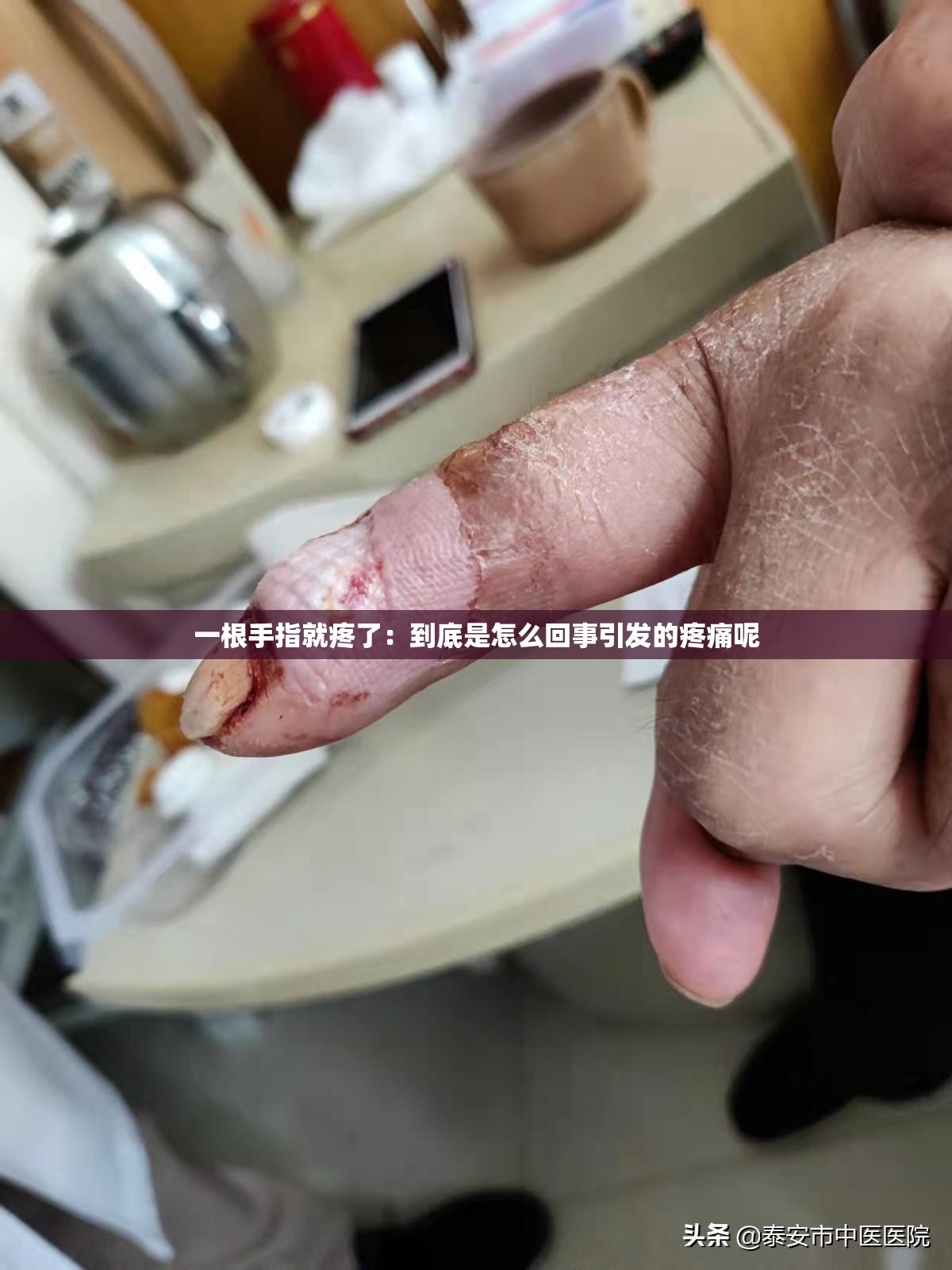 一根手指就疼了：到底是怎么回事引发的疼痛呢